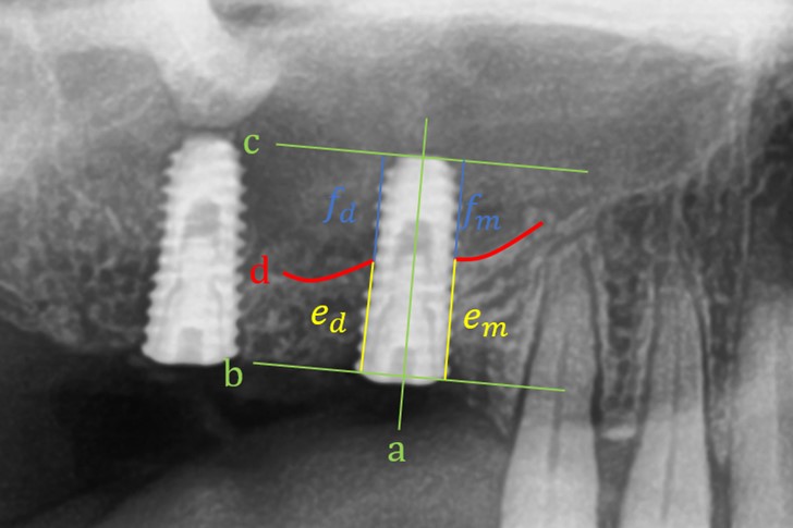 Endosinus Bone Gain after Osteotome Sinus Floor Elevation Without Bone ...